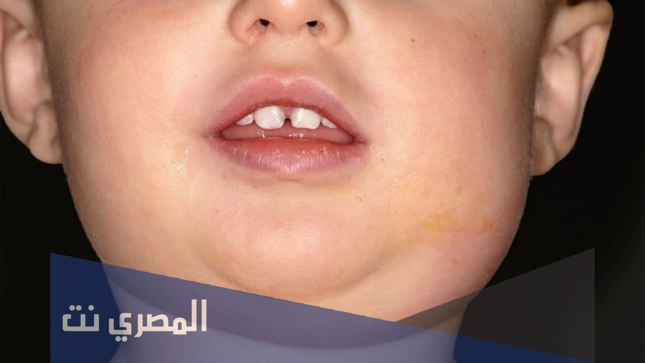 أعراض مرض أبو دغيم