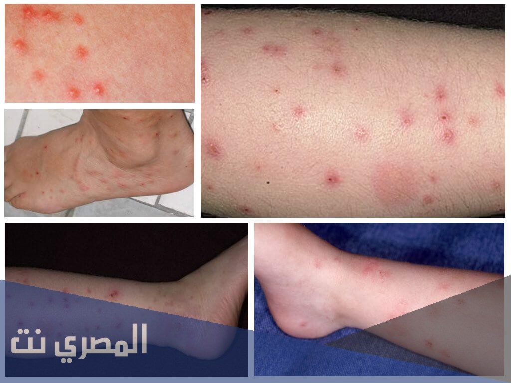 أعراض مرض الطاعون وعلاجه