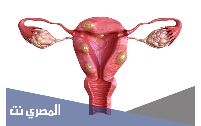 ادوية علاج بطانة الرحم المهاجرة