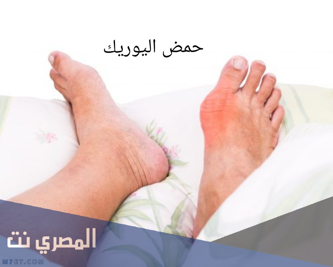 اسباب ارتفاع اليوريك أسيد في الجسم
