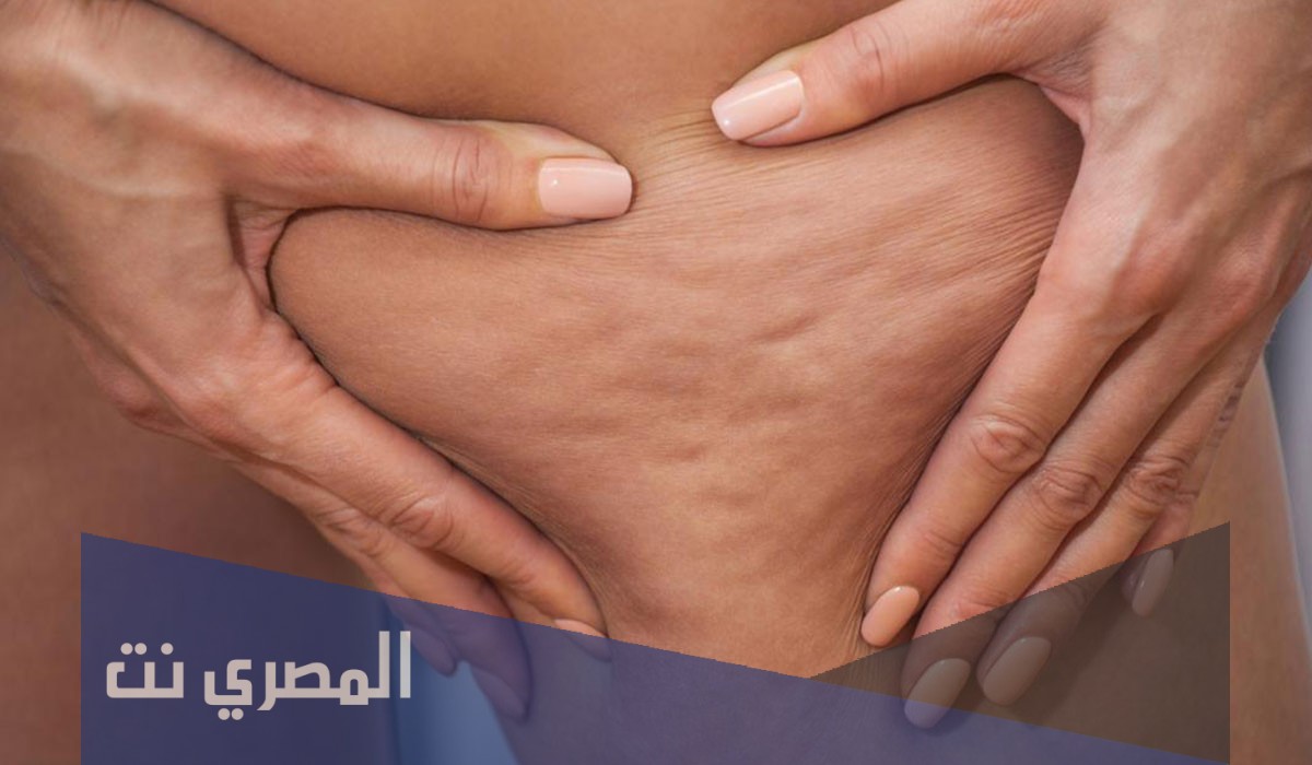 اسباب السيلوليت وكيفية التخلص منه