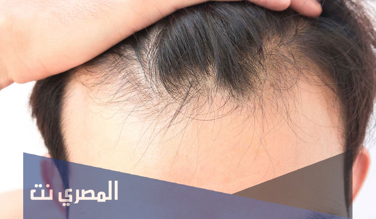 اسباب تساقط الشعر عند الرجال وطرق علاجه