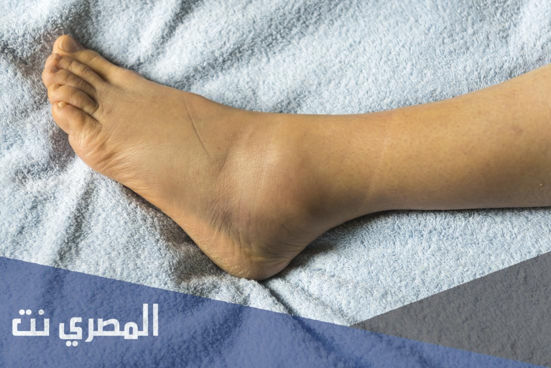 اسباب تورم القدمين عند النساء