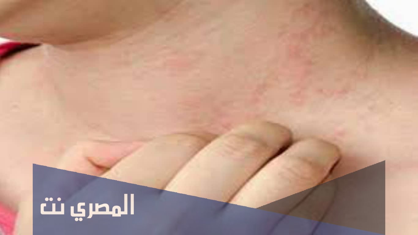 انواع الحساسية من الأكل وعلاجها