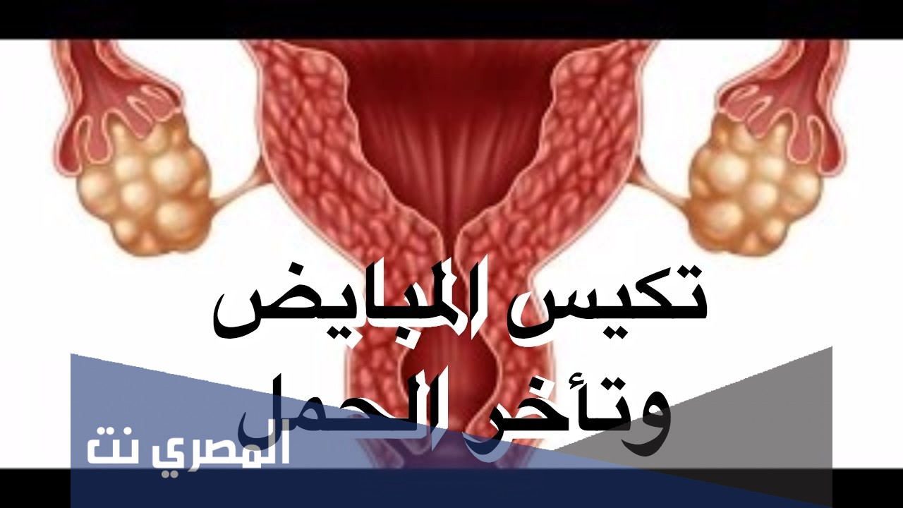 تأثير كيس المبيض على الحمل