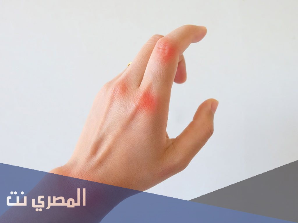 علاج التهاب المفاصل