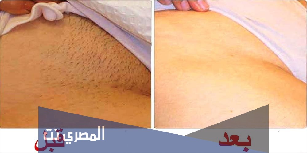 تبييض الأماكن الحساسة من الداخل
