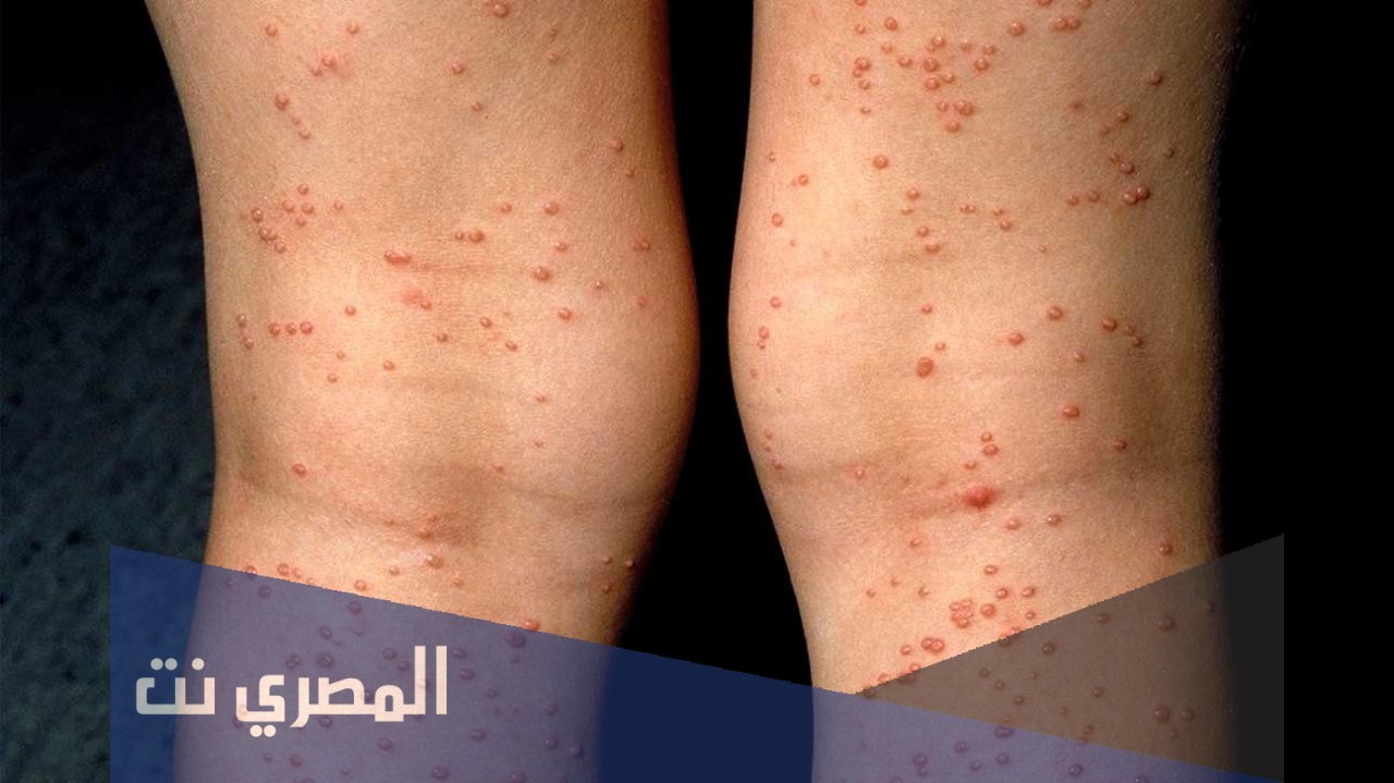 تعريف الإيدز وطرق الوقاية منه