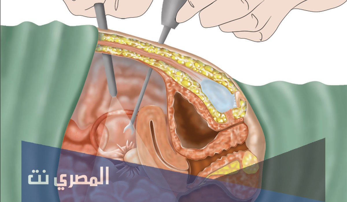 حكم إجراء عملية تضييق المهبل