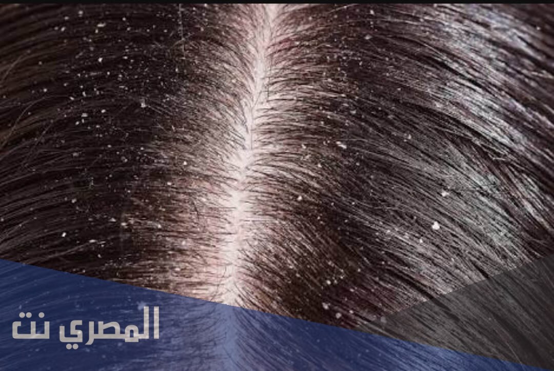 شامبو داندي فيرا Dandivera لعلاج قشرة الرأس