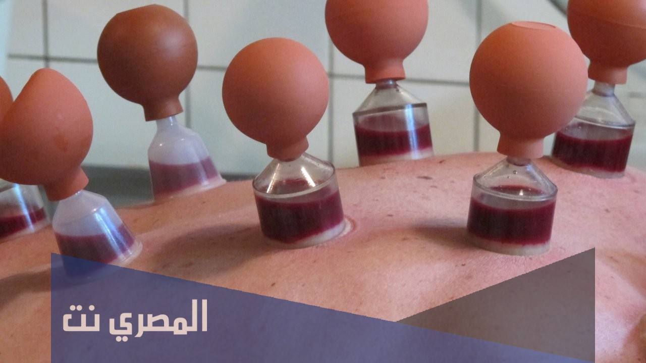 شروط الحجامة واوقاتها