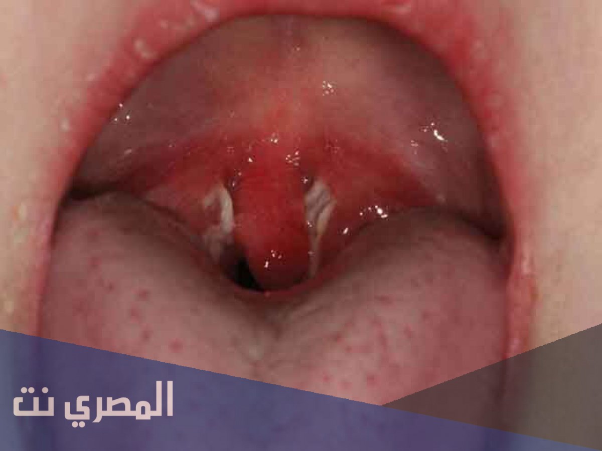 صديد اللوز اسبابه وعلاجه