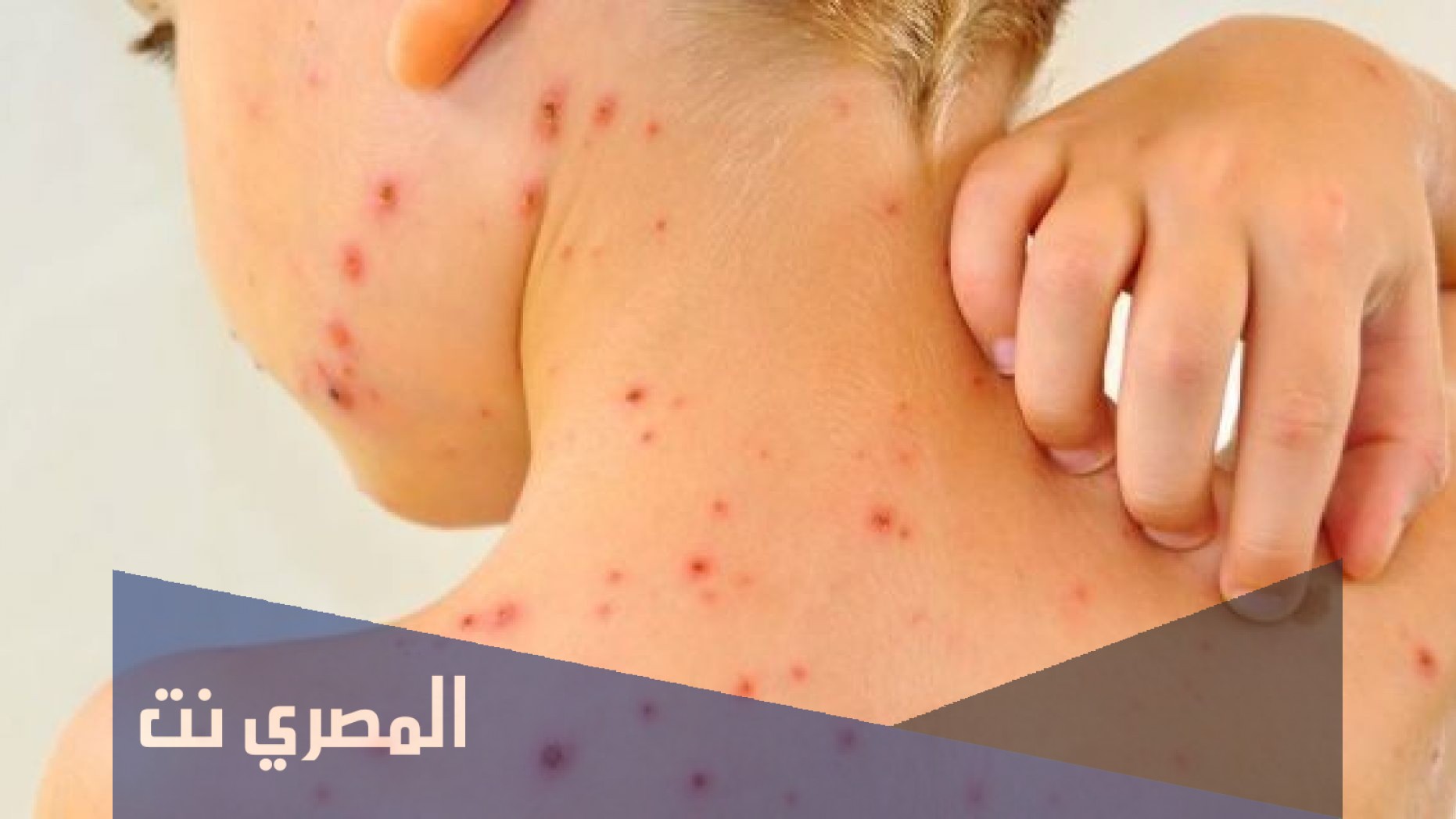 طرق انتقال عدوى العنقز