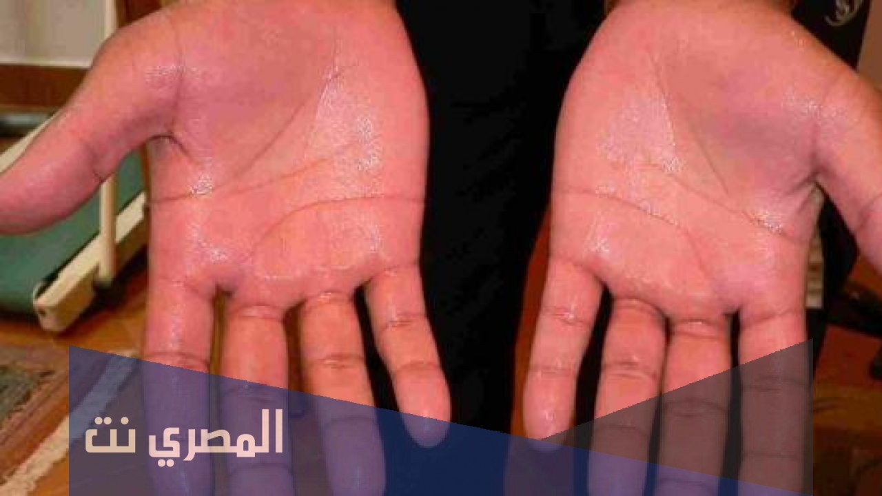 طرق علاج تعرق اليدين بالشاي