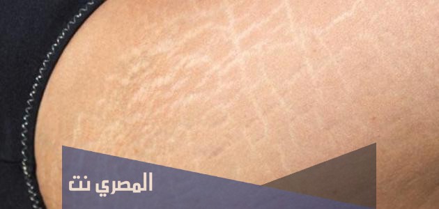طريقة علاج الخطوط البيضاء