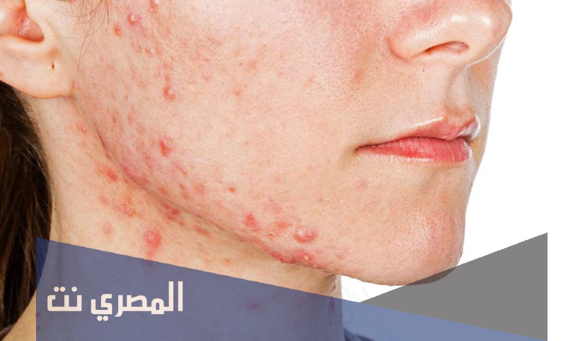 ظهور حبوب على الجسم في الحمل