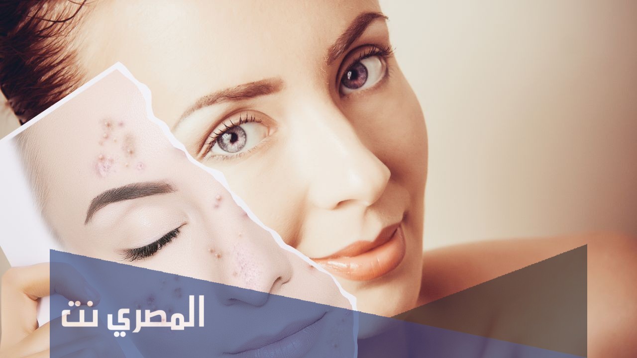 علاج اثار الحبوب وكيفيه ازالتها