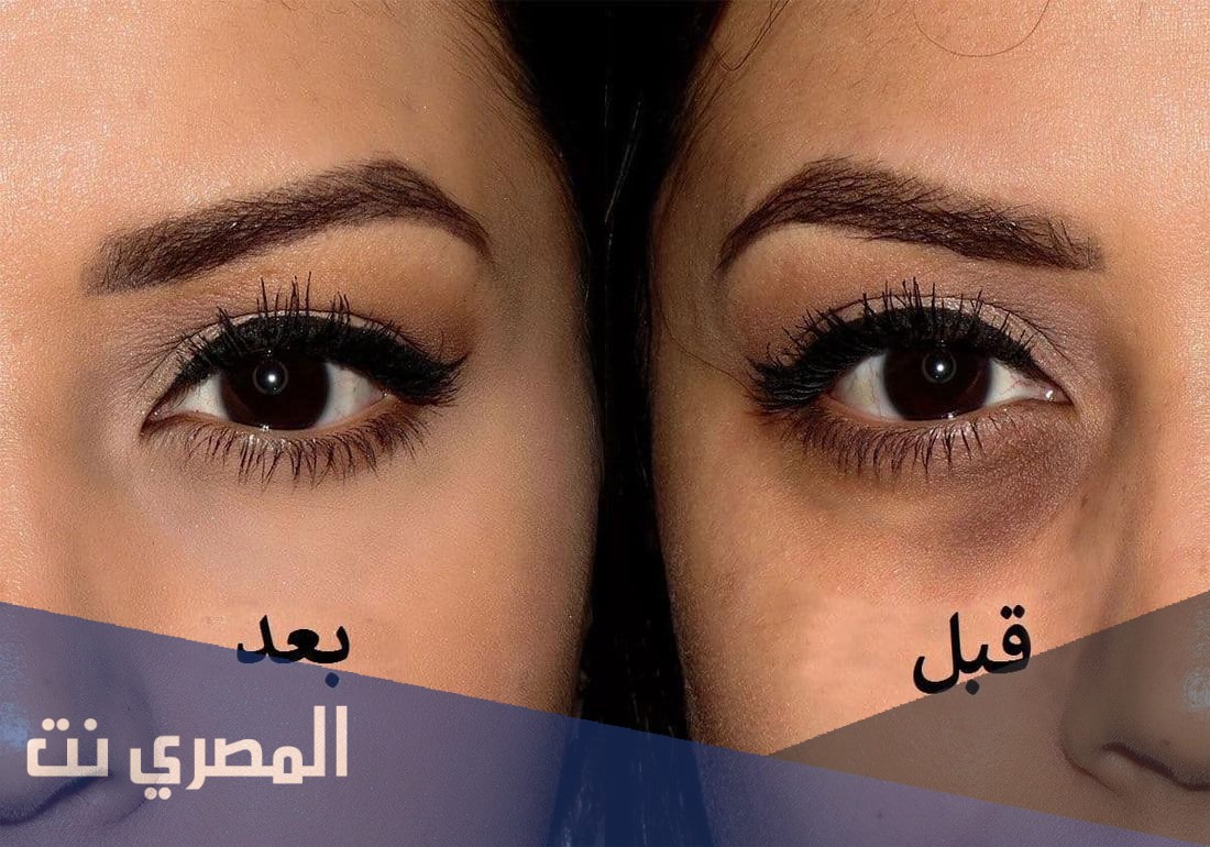 علاج الهالات السوداء تحت العين