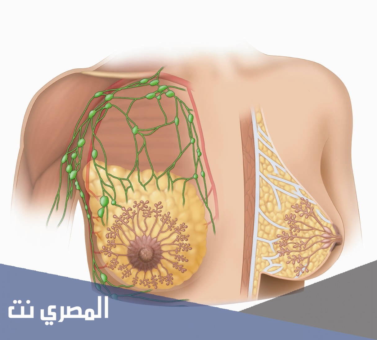 علاج تحجر الثدي بالأعشاب