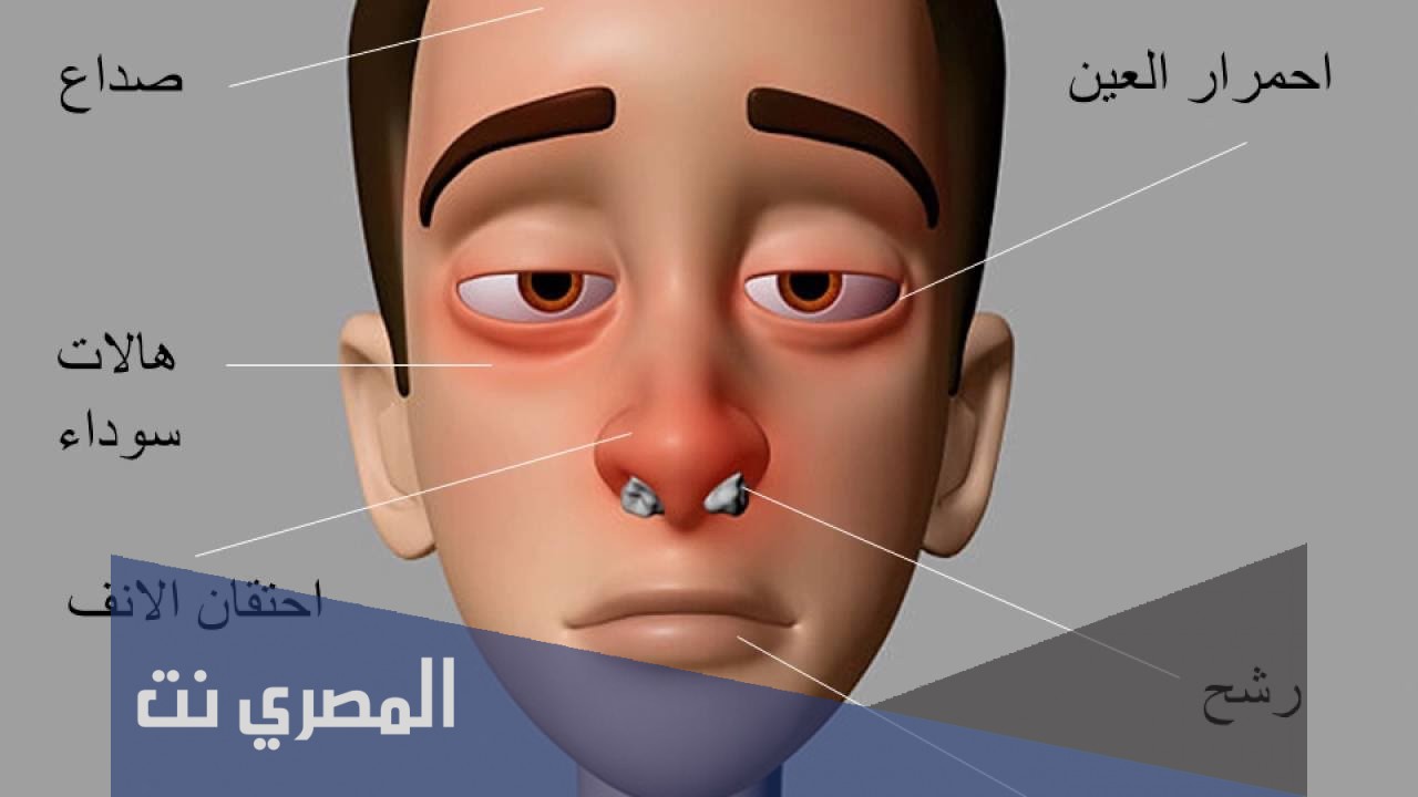 علاج حساسية الأنف نهائيًا