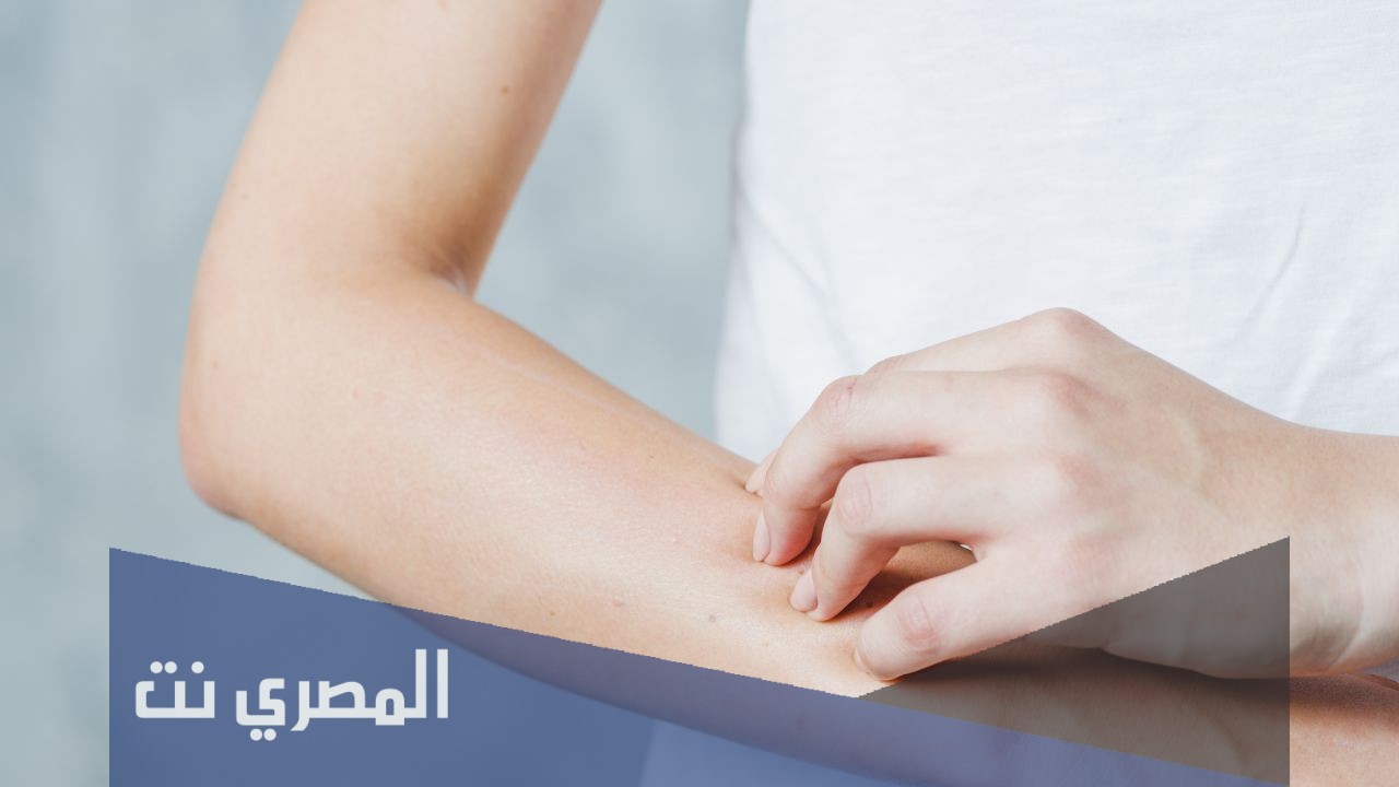 علاج حساسية السلفا