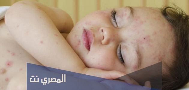 علاج حمو النيل للأطفال بالنشا