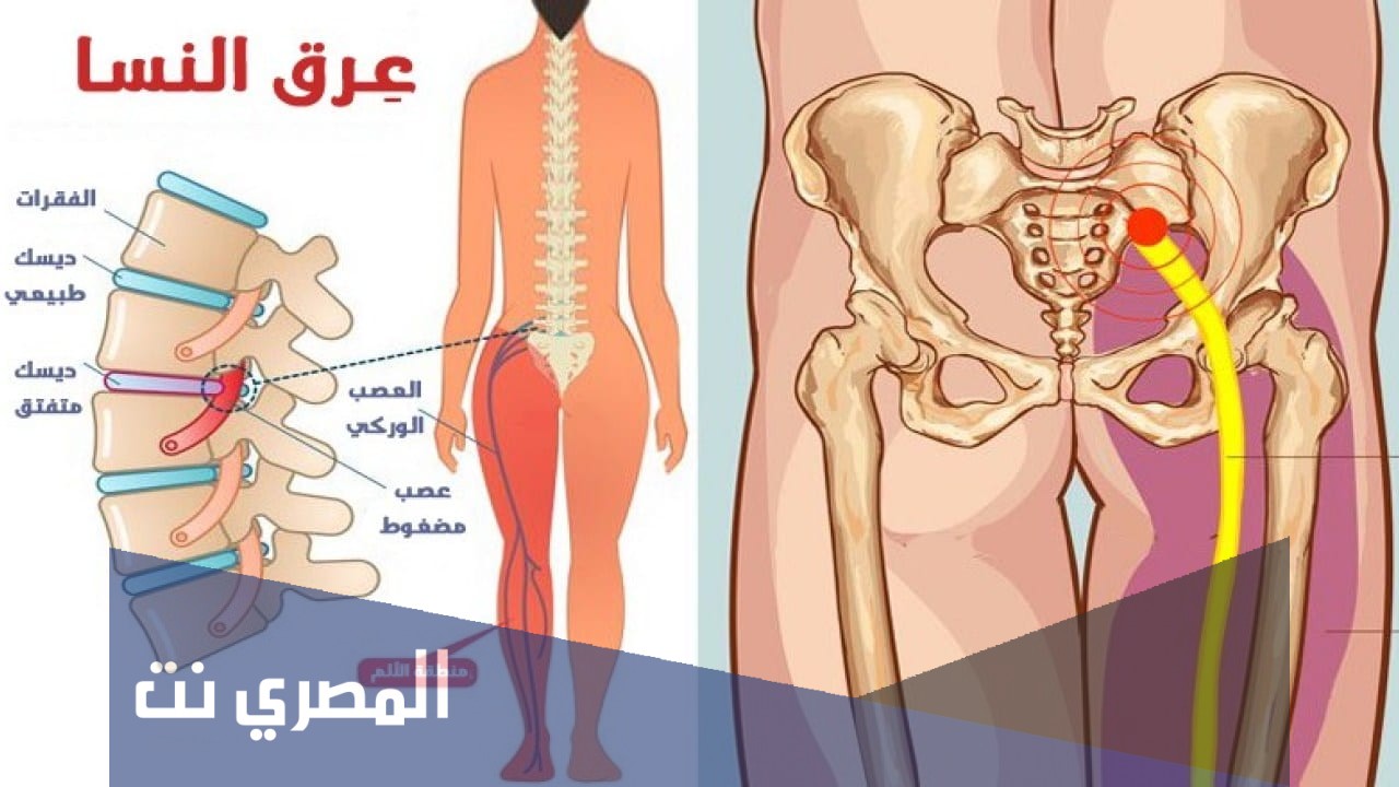 علاج عرق النسا بالزنجبيل وزيت السمسم
