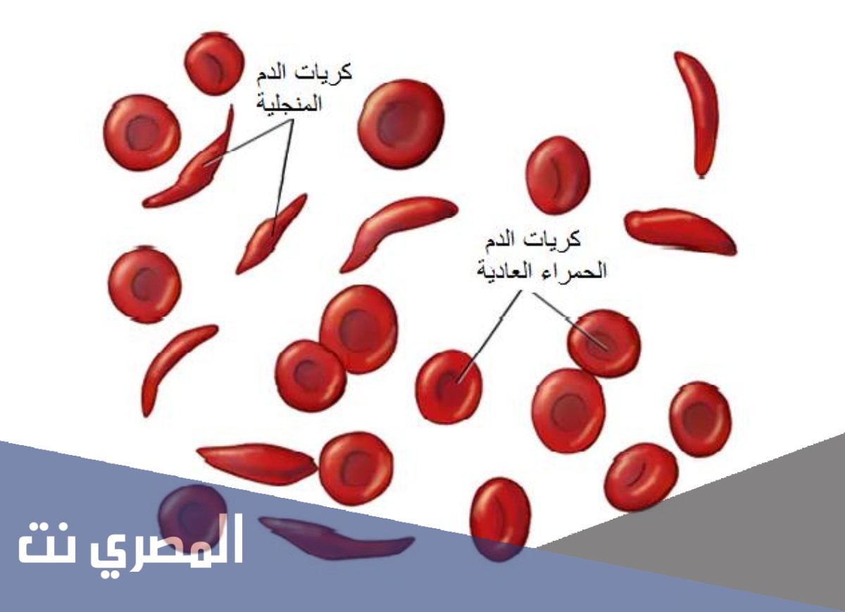 علاج فقر الدم المنجلي
