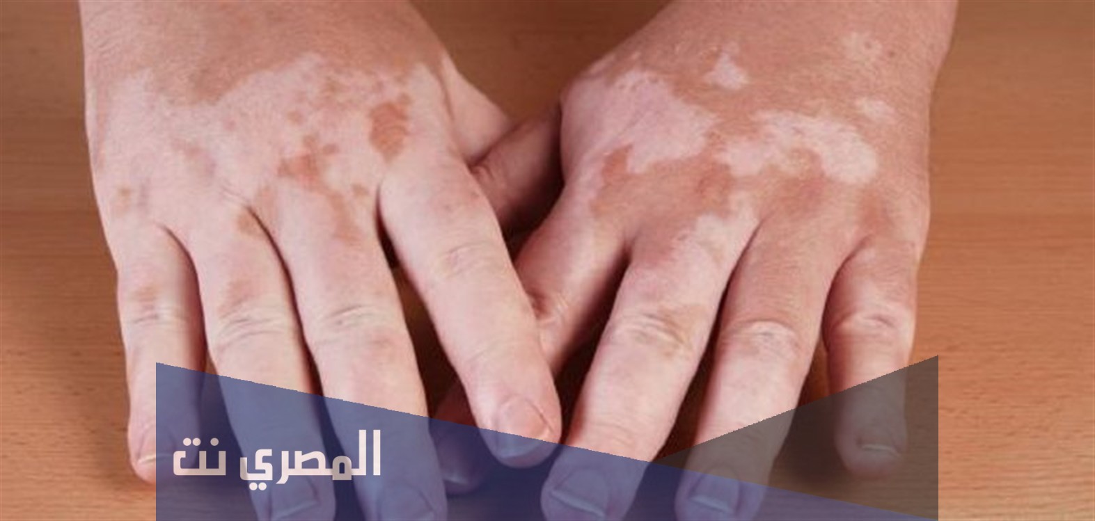علاج مرض البهاقعلاج مرض البهاق