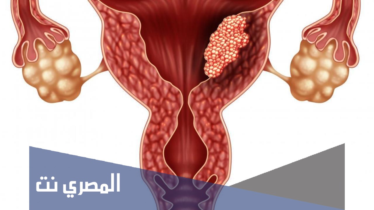 علاج ورم الرحم الحميد والخبيث