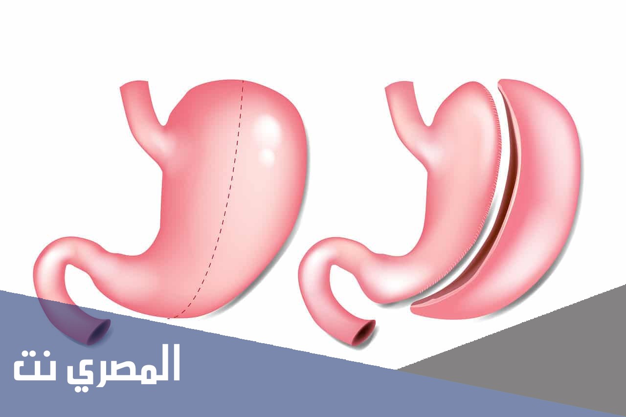 عملية تكميم المعدة وأضرارها