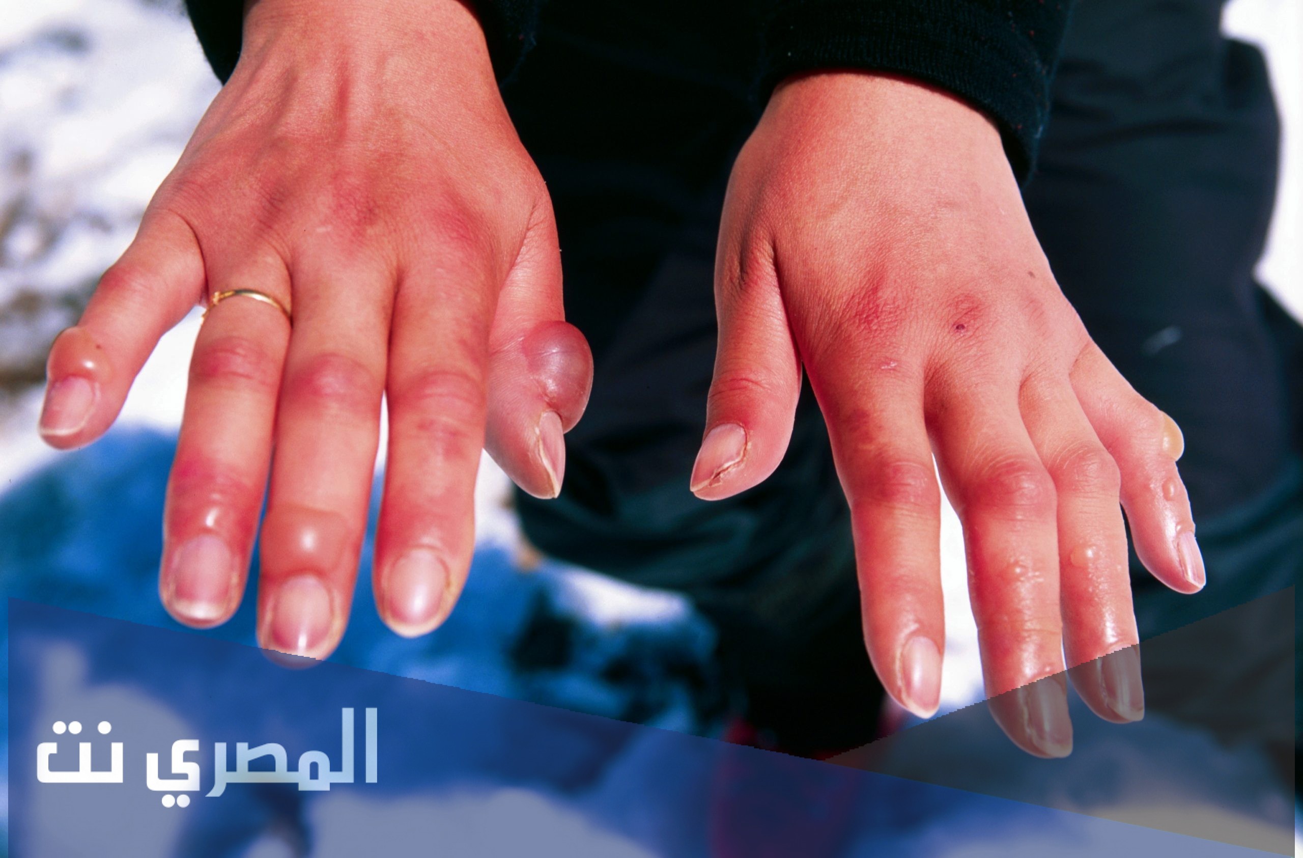 قضمة الصقيع ما هي