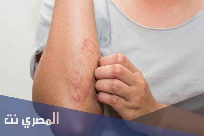 كريم توبيكورت لعلاج الاكزيما والصدفية Topicort