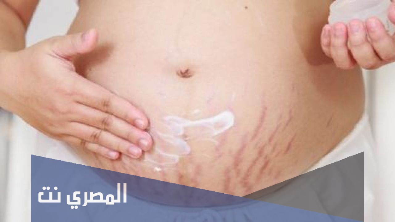 كيف أزيل تشققات الحمل بعد الولادة؟