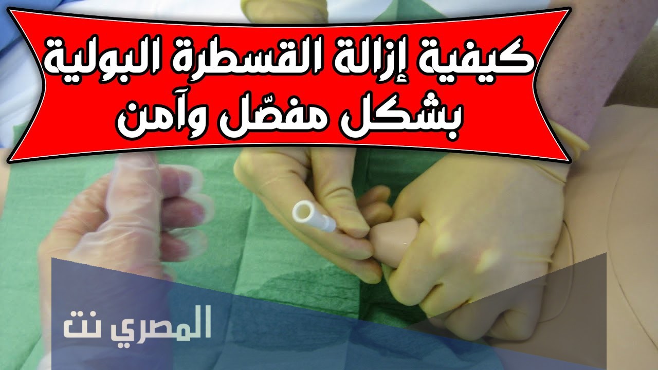 كيفية ازالة قسطرة الحالب