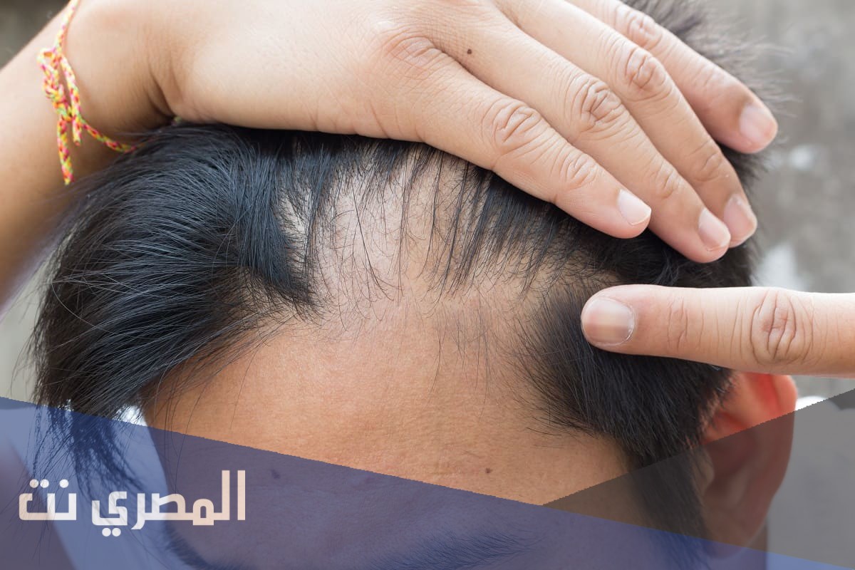 كيفية استخدام العسل للشعر الخفيف