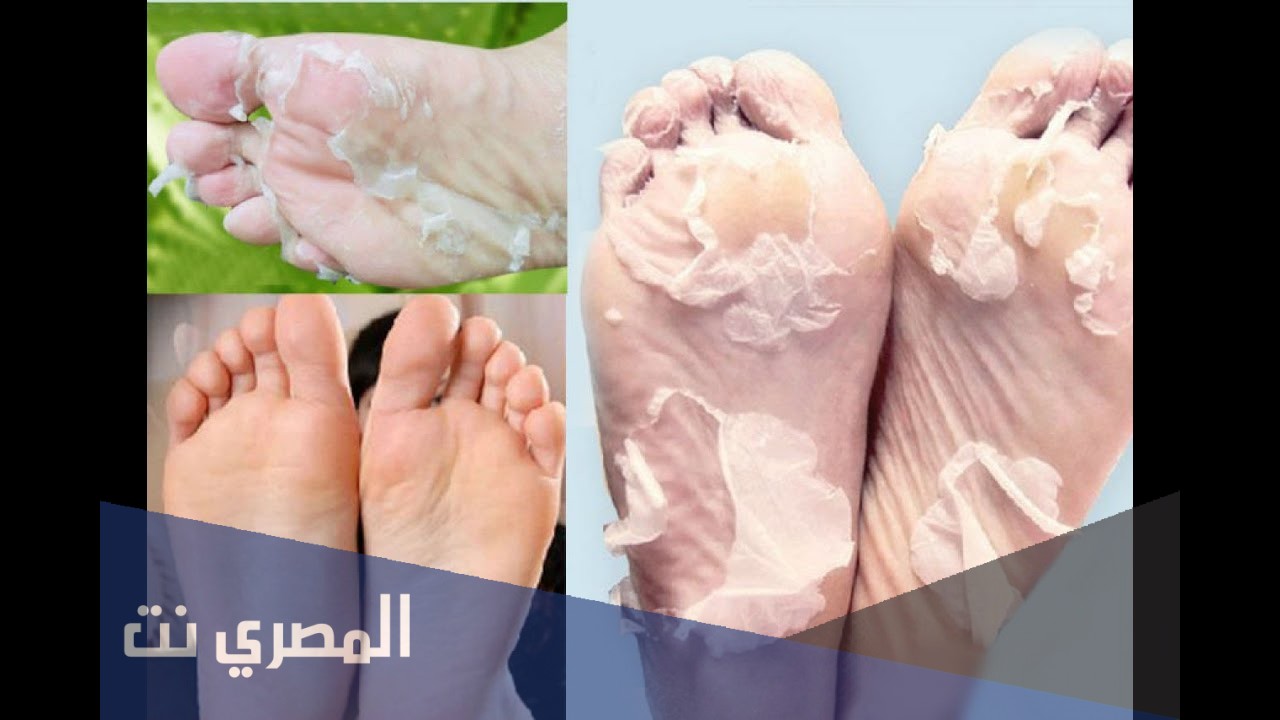 كيفية التخلص من خشونة القدمين بالأعشاب