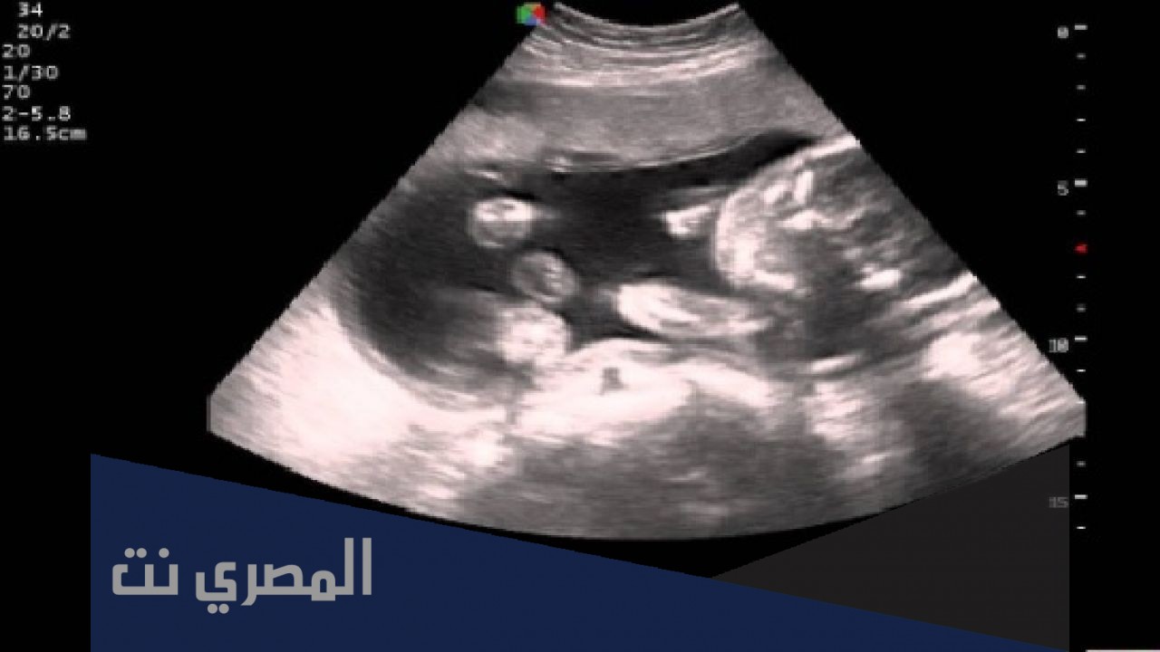 كيفية تشخيص الأمراض الوراثية عند الجنين أثناء الحمل