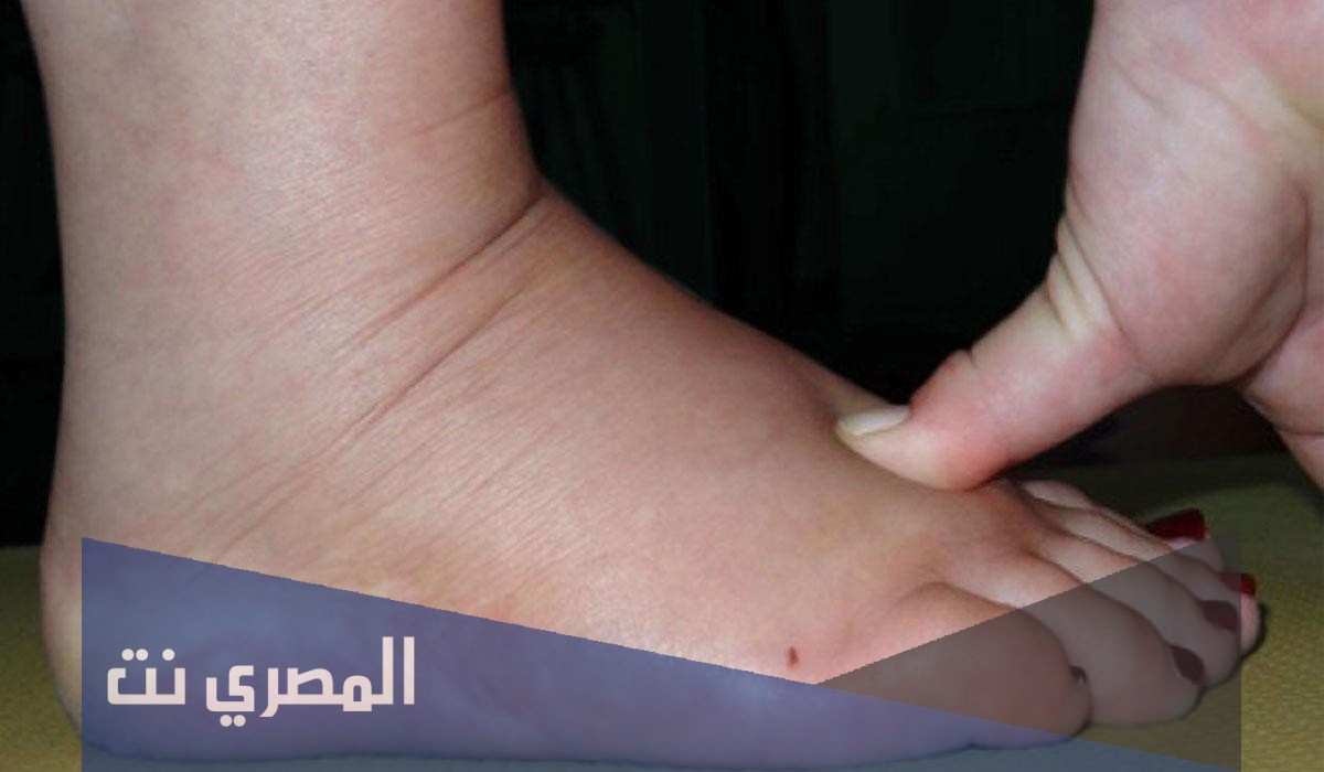 كيفية علاج تورم القدمين عند كبار السن