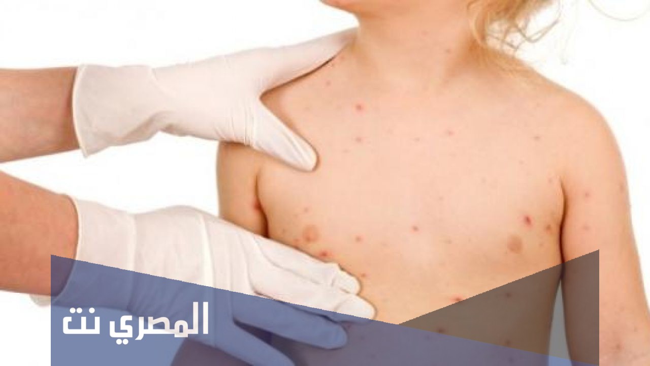 كيفية علاج جدري الماء