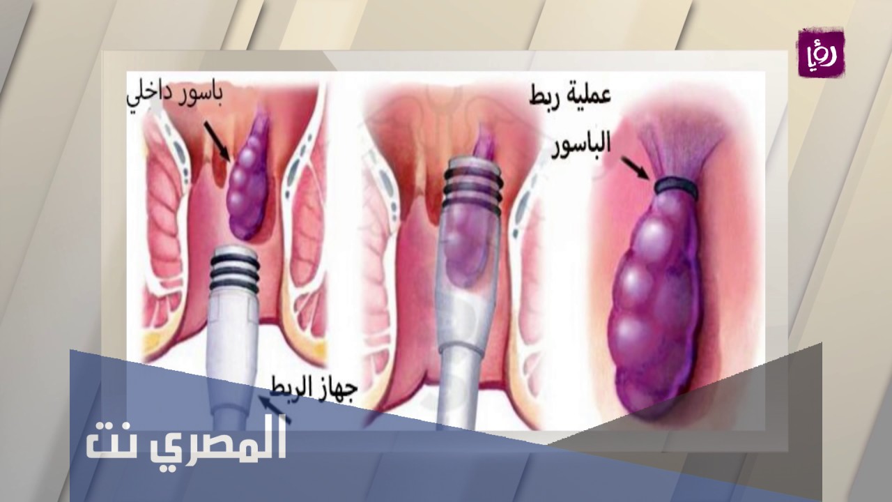 كيفية وقف نزيف البواسير والشرخ