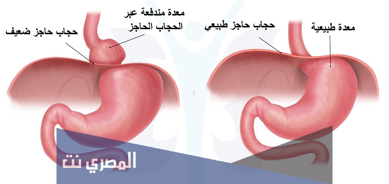 ما هو فتق المعدة وعلاجه