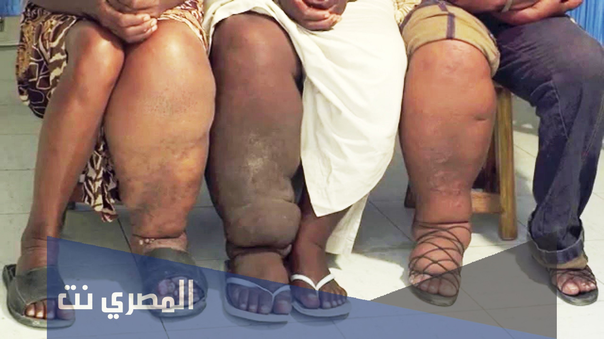 ما هو مرض داء الفيل واعراضه