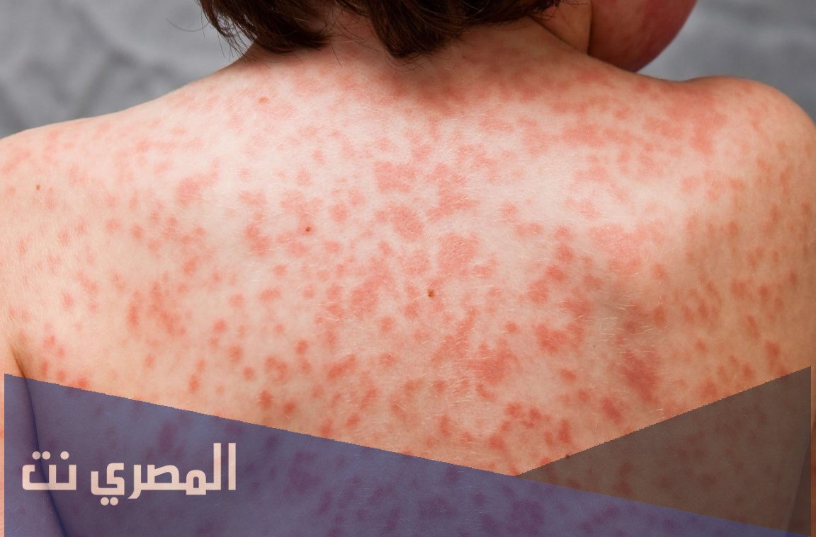 ما هو مرض كاواساكي وأعراضه؟
