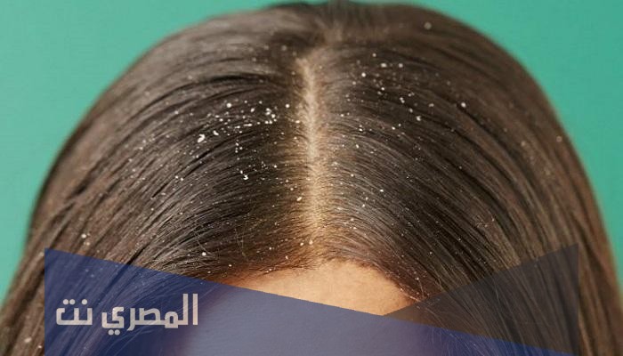 ما هي قشرة الشعر وعلاجها