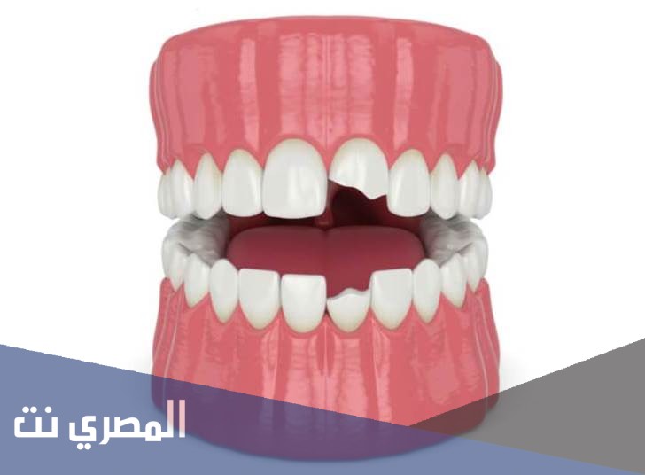 ماذا تسمى عمليه كسر السن