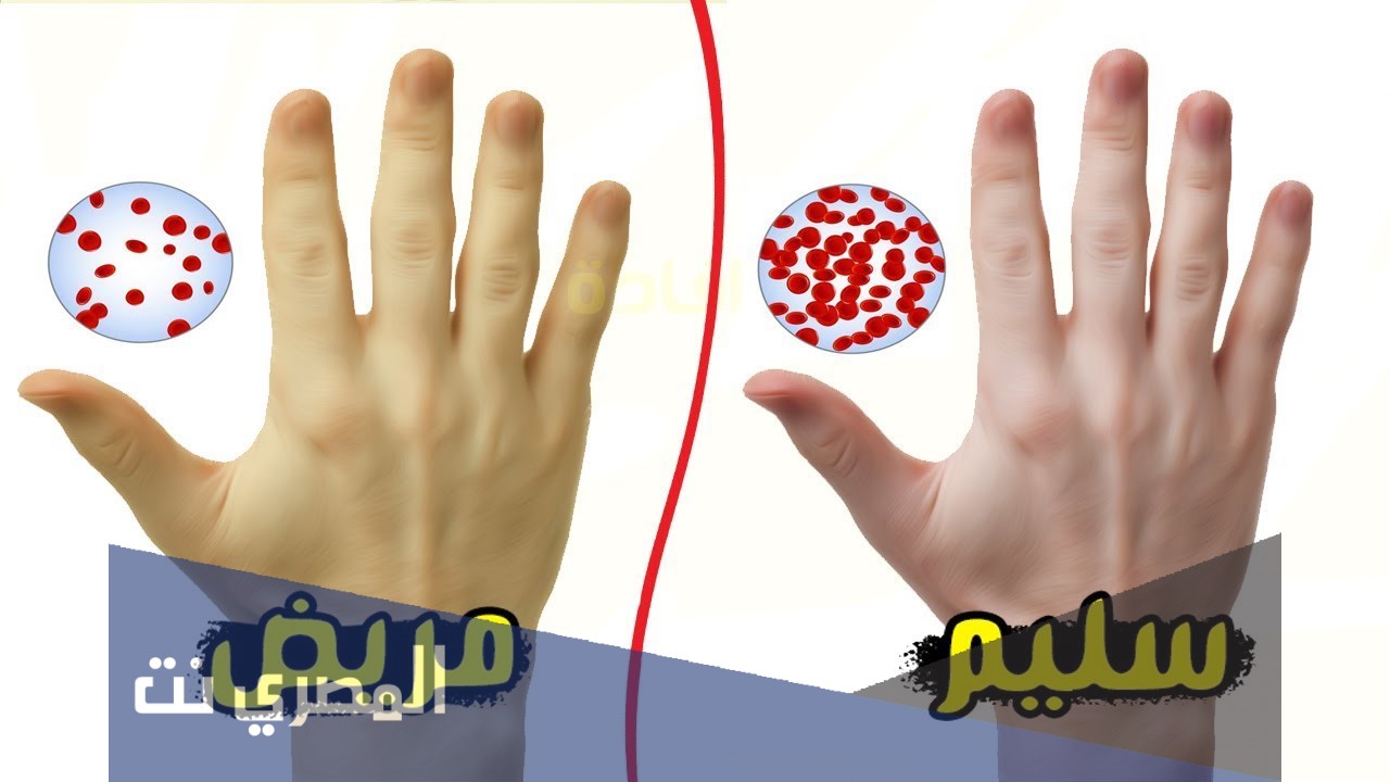 ماذا يطلق على مرض فقر الدم