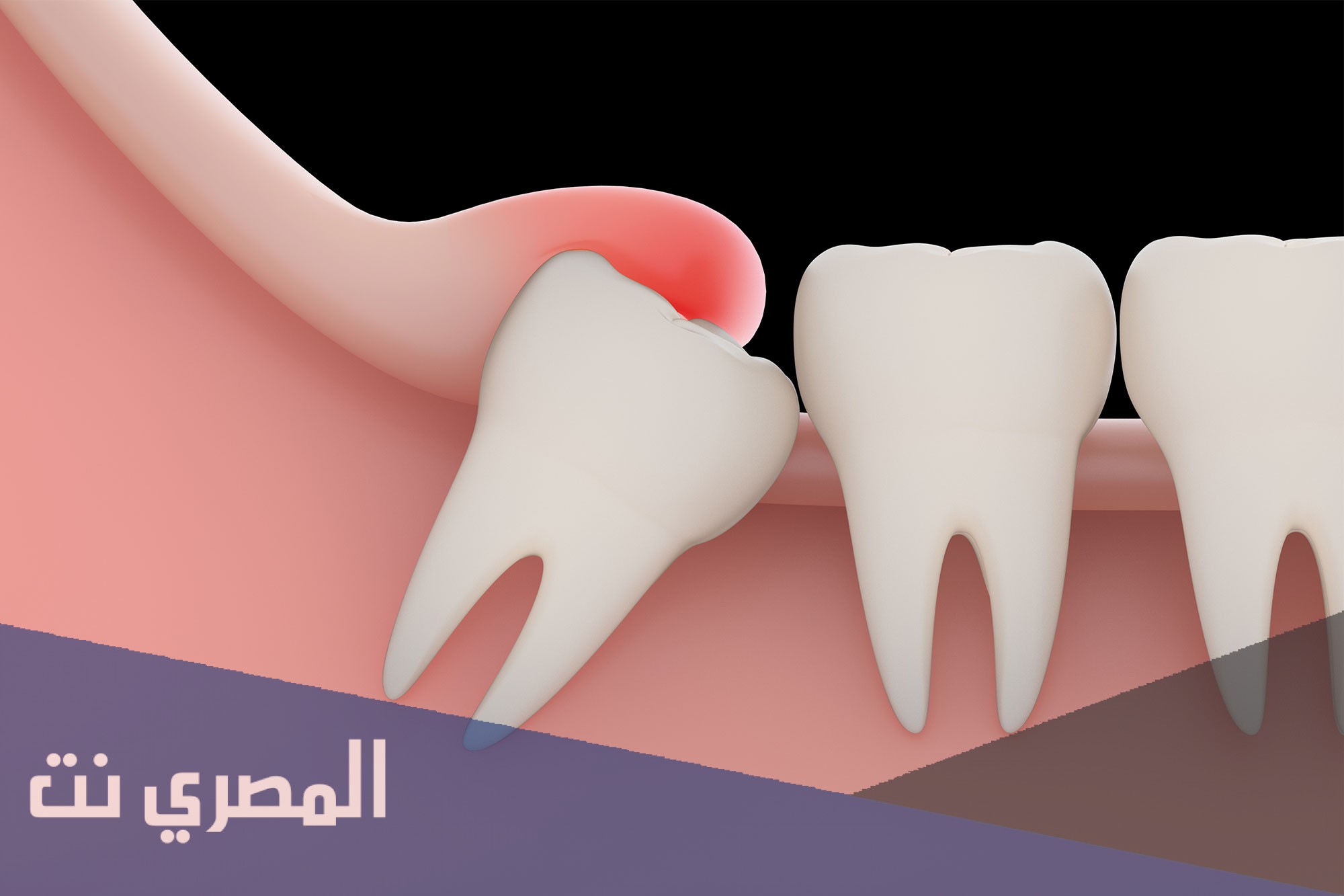 كم مدة ألم ظهور ضرس العقل