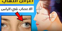 معلومات عن اعراض التهاب الاعصاب في الرأس