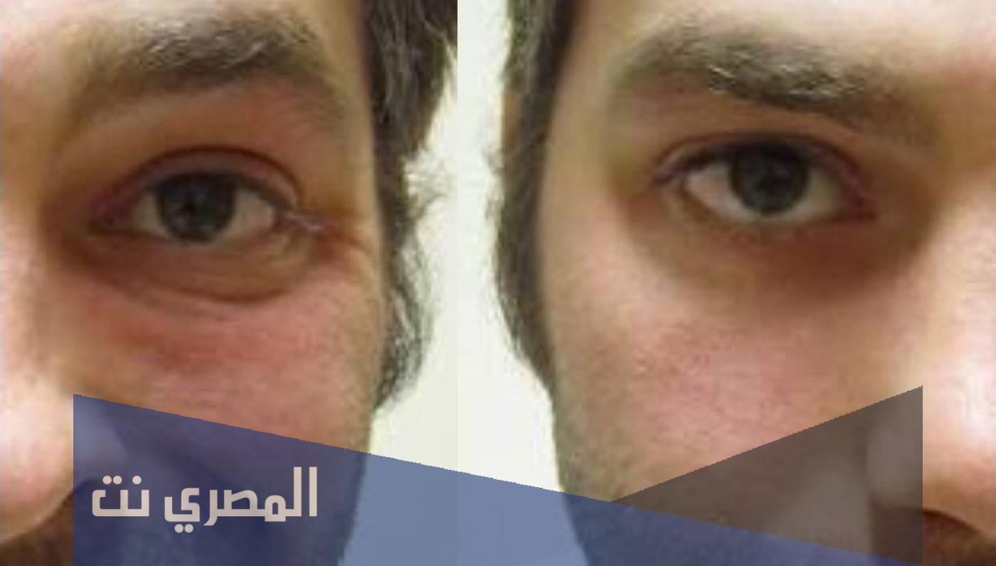 معلومات عن علاج العصب السابع